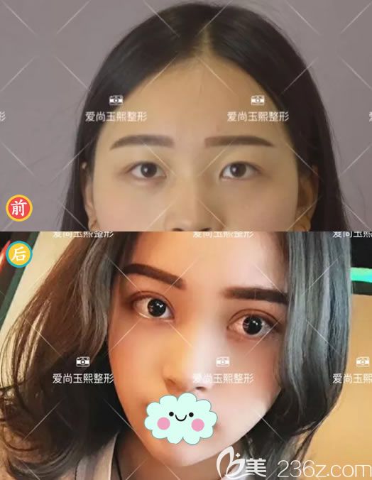 鄭靜偉院長(zhǎng)雙眼皮案例 鄭靜偉院長(zhǎng)雙眼皮案例
