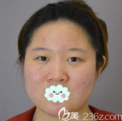 在<!--<i data=20240703-sp></i>-->做鼻綜合隆鼻前 在<!--<i data=20240703-sp></i>-->做鼻綜合隆鼻前