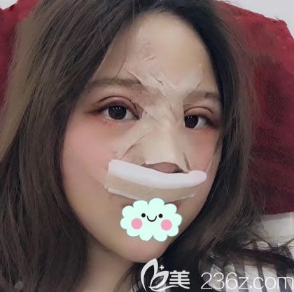 剛做完肋軟骨鼻綜合隆鼻效果 剛做完肋軟骨鼻綜合隆鼻效果