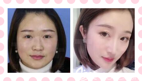 重慶時光隆鼻好不好？