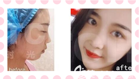 重慶時光醫(yī)院能墊下巴嗎？