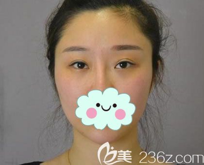 天生的雙眼皮卻左右不對稱 天生的雙眼皮卻左右不對稱