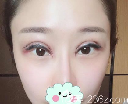 剛做完雙眼皮手術(shù)圖片 剛做完雙眼皮手術(shù)圖片