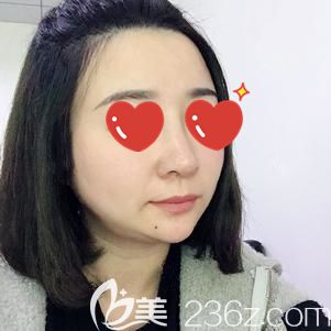 貪便宜做假體隆鼻歪斜后糾結許久到武漢美基元做了鼻部修復，才明白想要好效果就要找正規(guī)機構