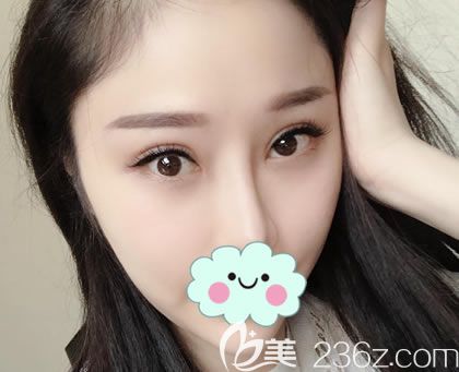 在<!--<i data=20240703-sp></i>-->做雙眼皮矯正30天后 在<!--<i data=20240703-sp></i>-->做雙眼皮矯正30天后