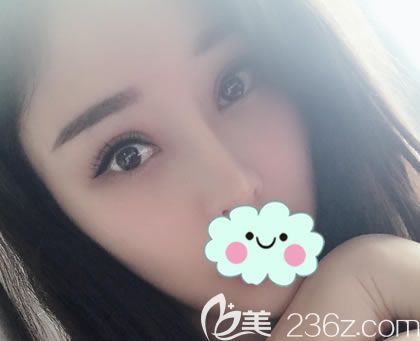 我雖然是天生雙眼皮,但雙眼皮不對稱,考慮后選擇鄭靜偉做了雙眼皮和開眼角