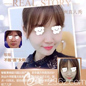 五洲萊美黃媛媛主任做超皮秒祛斑真人案例