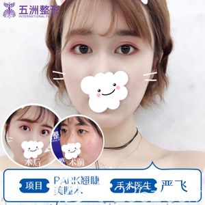 嚴(yán)飛院長做精切雙眼皮術(shù)前術(shù)后對比