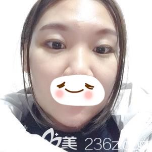 石家莊天宏張學(xué)雷為我做內(nèi)切祛眼袋術(shù)后12天效果明顯