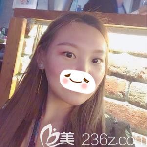 隨著年齡增長(zhǎng)眼袋深超顯老 在石家莊天宏面診張學(xué)雷醫(yī)生建議我做內(nèi)切去眼袋手術(shù) 恢復(fù)25天后效果好還毫無痕跡