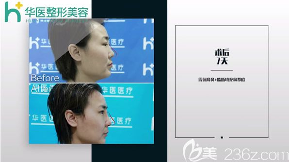 華醫(yī)宋耀宗硅膠假體隆鼻+自體軟骨隆鼻第天效果