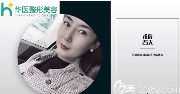 呼和浩特華醫(yī)宋耀宗鼻綜合隆鼻25天恢復(fù)圖片