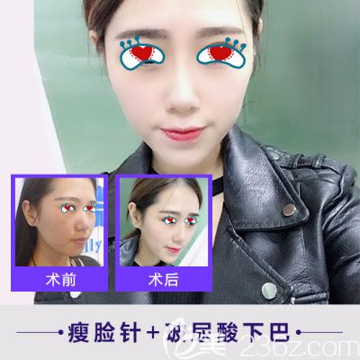 合肥崔勁松瘦臉+玻尿酸豐下巴前后效果對(duì)比圖