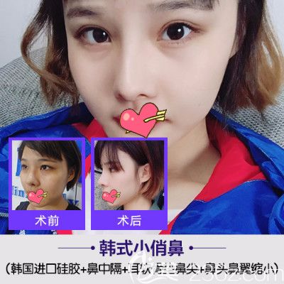 合肥哪家醫(yī)院龍隆鼻比較好？崔勁松整形鼻綜合案例效果來驗(yàn)證