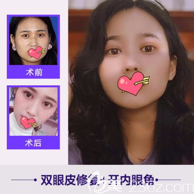 合肥崔勁松整形雙眼皮失敗修復(fù)案例公布