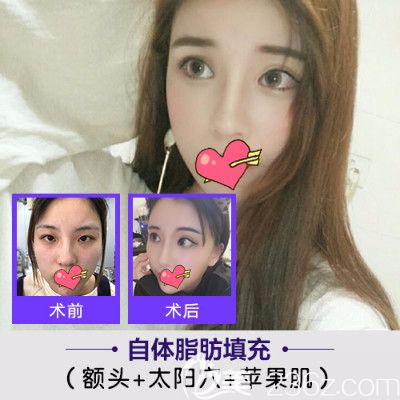 崔勁松整形自體脂肪填充額頭+太陽穴+蘋果肌前后效果對(duì)比