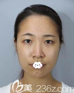 韓國樂希lush整形外科韓式眼綜合+鼻綜合隆鼻案例 韓國樂希lush整形外科韓式眼綜合+鼻綜合隆鼻案例