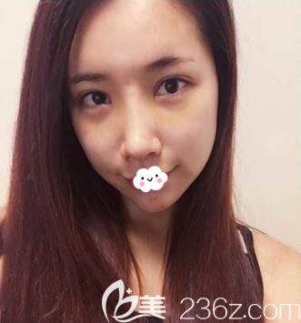 韓國樂希lush整形外科韓式眼綜合+鼻綜合隆鼻術(shù)后1周恢復(fù)效果圖 韓國樂希lush整形外科韓式眼綜合+鼻綜合隆鼻術(shù)后1周恢復(fù)效果圖