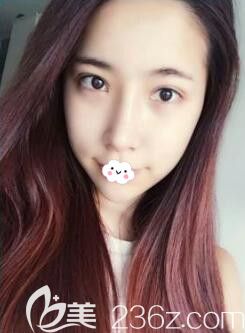 鼻綜合隆鼻一個月恢復(fù)不錯將韓國樂希lush整形外科韓式眼綜合照片+做鼻子案例公開