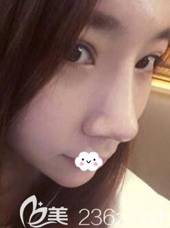 韓國樂希雙眼皮開眼角+假體隆鼻+耳軟骨墊鼻尖術(shù)后恢復(fù)效果圖 韓國樂希雙眼皮開眼角+假體隆鼻+耳軟骨墊鼻尖術(shù)后恢復(fù)效果圖