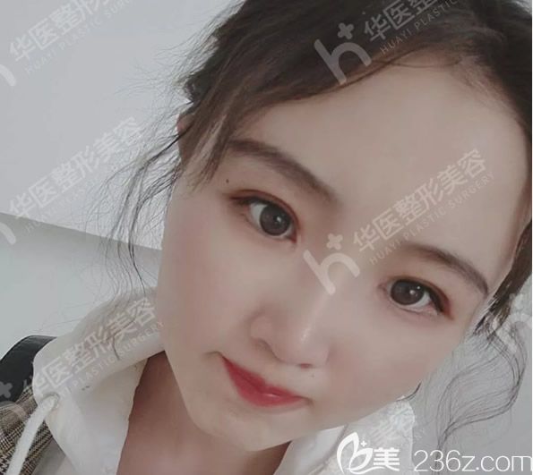 呼和浩特割雙眼皮哪家醫(yī)院好 這有華醫(yī)整形劉露院長眼綜合術后真實恢復期圖片和案例