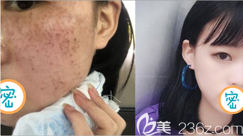 內(nèi)江達(dá)芬奇激光祛斑術(shù)前術(shù)后對(duì)比效果圖