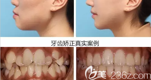無(wú)錫佳士潔口腔牙齒矯正真人案例前后對(duì)比效果圖