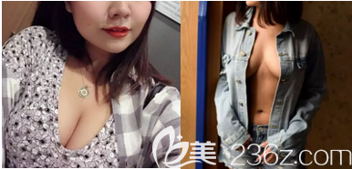 <!--<i data=20240703-sp></i>-->醫(yī)生給我做宮廷內(nèi)窺鏡復(fù)合隆胸第35天<span style=