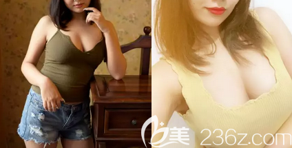 我在北京藝星做宮廷內(nèi)窺鏡假體復(fù)合隆胸第62天<span style=