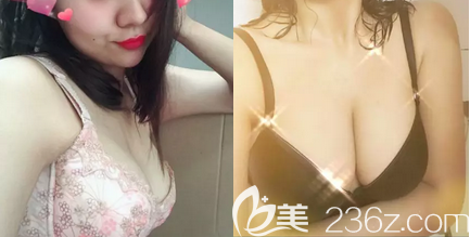 內(nèi)窺鏡假體隆胸怎樣？北京藝星宮廷內(nèi)窺鏡復(fù)合隆胸<span style=