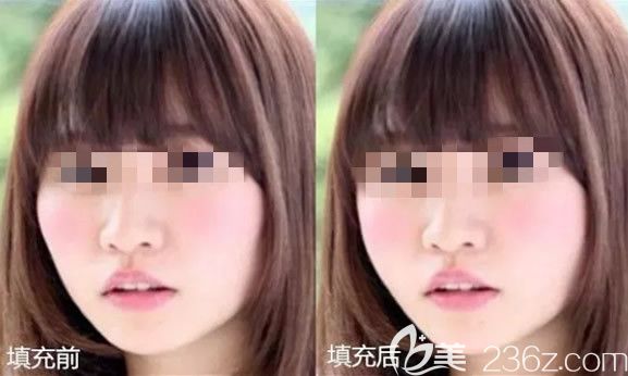 大寬臉做面部脂肪填充前后對(duì)比圖片