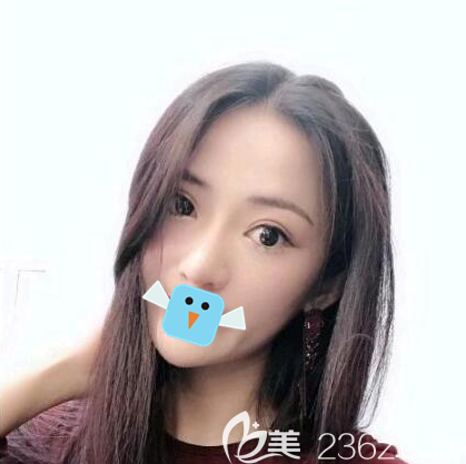 內(nèi)江達(dá)芬奇陳科激光去眼袋治療速度好快，半個(gè)多小時(shí)就結(jié)束了，完全不影響我正常工作