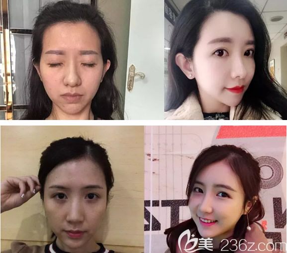 呼市華醫(yī)王春燕全臉脂肪填充效果案例圖