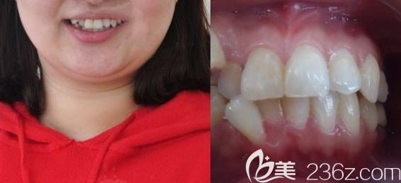 在無錫佳士潔口腔做牙齒矯正的術(shù)前照 在無錫佳士潔口腔做牙齒矯正的術(shù)前照