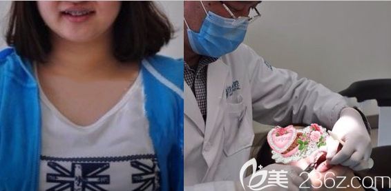 在無錫佳士潔口腔做金屬牙套矯正過程圖 在無錫佳士潔口腔做金屬牙套矯正過程圖