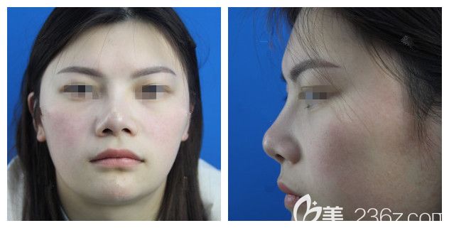 做了膨體隆鼻術后效果不自然 做了膨體隆鼻術后效果不自然