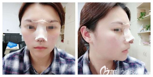剛做完全肋軟骨隆鼻術后效果 剛做完全肋軟骨隆鼻術后效果