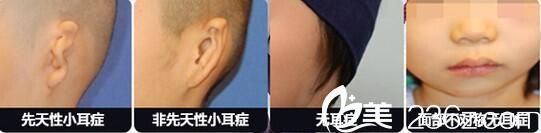 無(wú)耳癥、先天性、非先天性小耳癥圖片