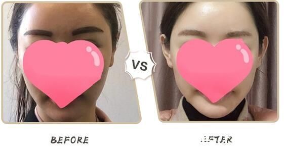 韓國(guó)貼發(fā)耳矯正案例前后效果對(duì)比圖