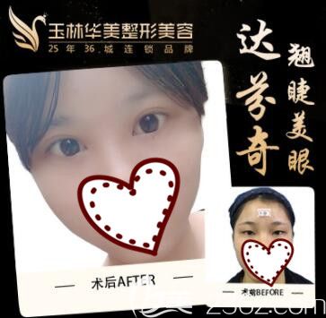 玉林華美整形全切雙眼皮加開(kāi)內(nèi)眼角案例