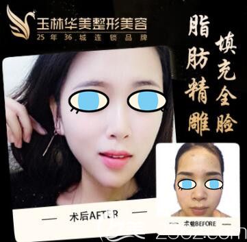 玉林華美全臉自體脂肪填充案例