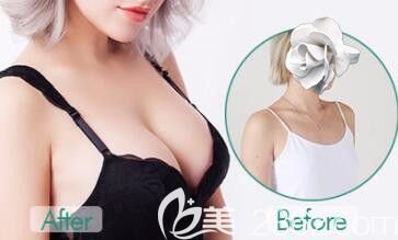 玉林華美整形自體脂肪隆胸案例