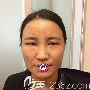 高海燕醫(yī)生給我做自體脂肪面部填充第4天樣子