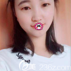 北京米蘭柏羽麗都自體脂肪填充技術(shù)怎么樣？我在北京米蘭柏羽麗都做面部脂肪填充效果告訴你