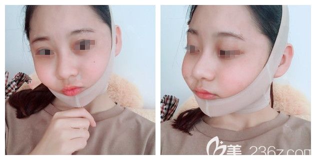 剛做完面部吸脂術(shù)后戴著頭套塑形