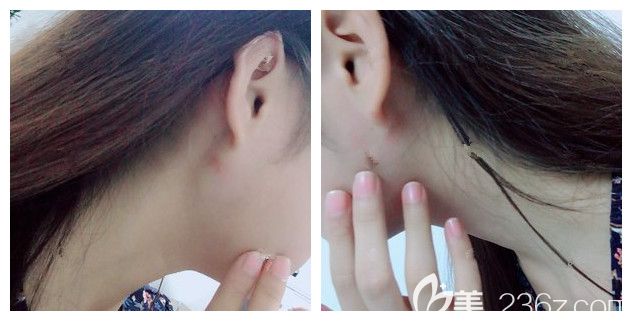 術(shù)后十天面部吸脂的恢復情況