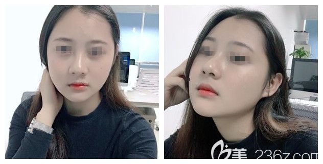 一個月后面部吸脂的輪廓已經(jīng)基本顯現(xiàn)