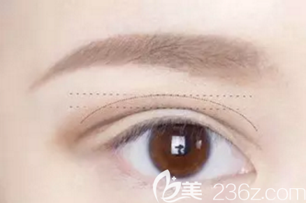 清潭first整形外科醫(yī)院成鎮(zhèn)模雙眼皮修復(fù)技術(shù)