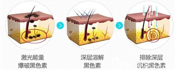 激光祛痣會不會留疤