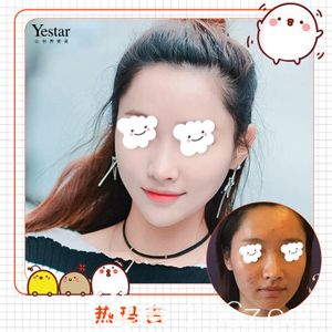 武漢藝星做熱瑪吉術(shù)后緊致肌膚淡化細紋